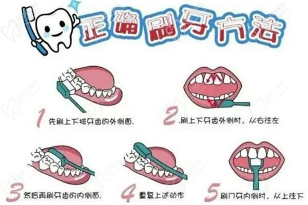 预防牙周脓肿保持良好口腔习惯