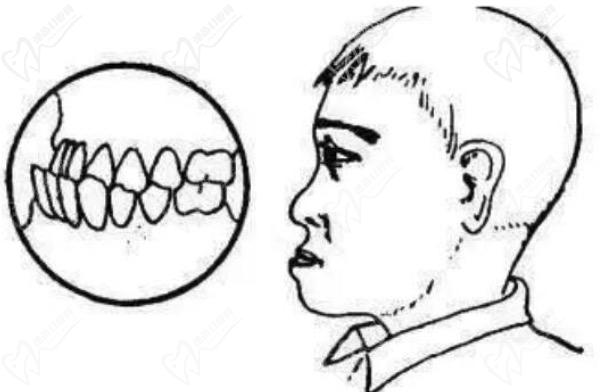 儿童骨性反颌怎么矫正？