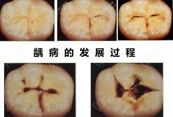 小黑点轻微蛀牙要补吗