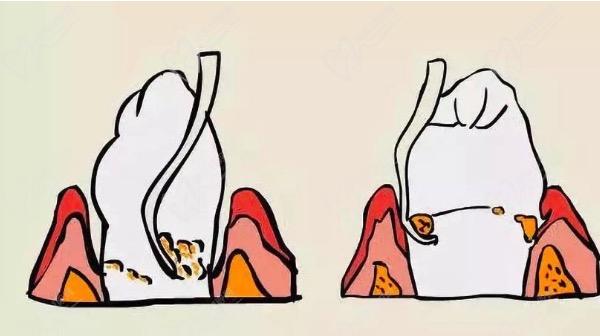 牙根炎和牙髓炎的区别都有哪些？