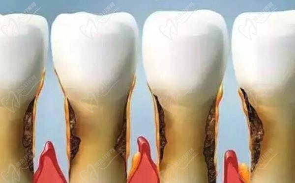 牙龈和牙齿分离是什么原因？