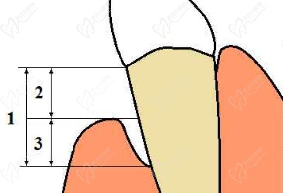 牙龈和牙齿分离是什么原因？
