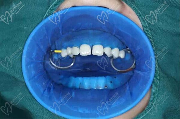 牙科橡皮障