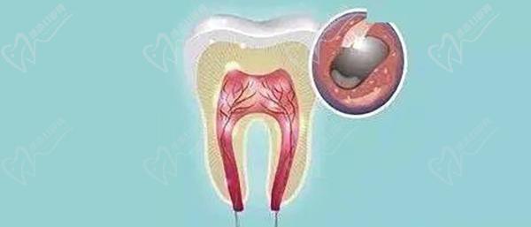 牙髓息肉怎么治疗