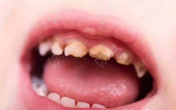 幼儿牙齿黄斑能刷掉吗？