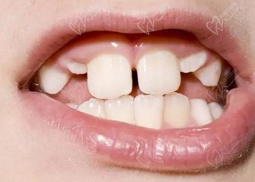 儿童牙齿长错位图片