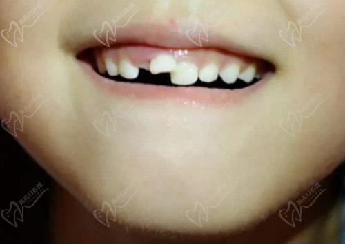 儿童牙齿长错位了怎么办？