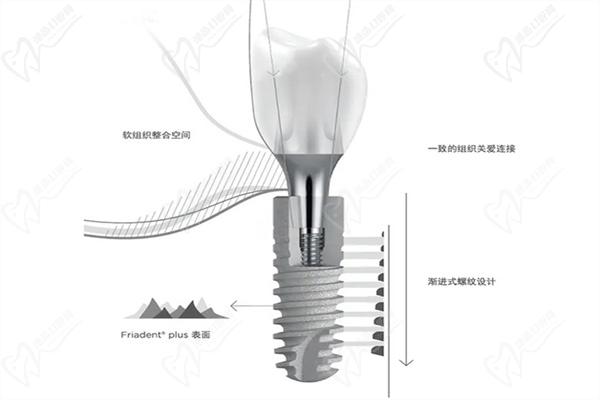 登士柏德国Ankylos（费亚丹）种植体