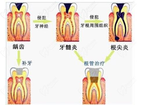 牙髓炎怎么治疗有效