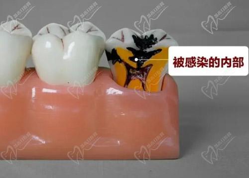 牙髓炎治疗方法