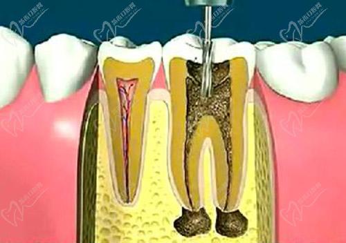 牙髓炎怎么治疗