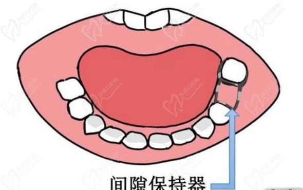 儿童牙齿间隙保持器有必要做吗？