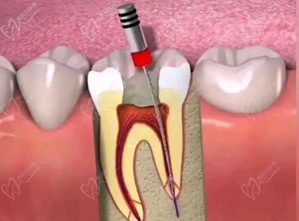 牙齿杀神经和根管治疗的区别哪个好一点