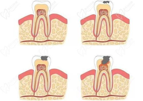 牙髓炎早期症状