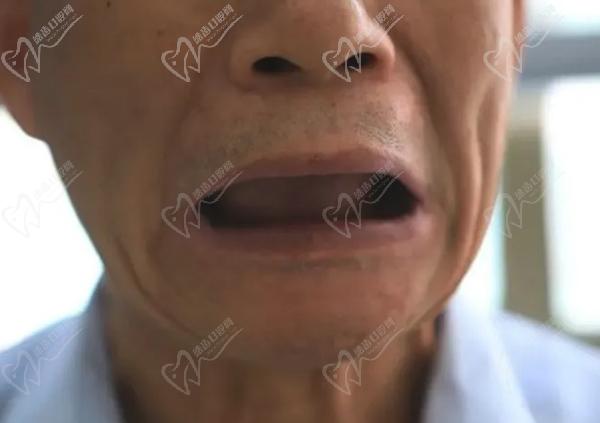 多大年龄不能种植牙了，70岁老人适合种植牙吗？八十几岁的老人呢