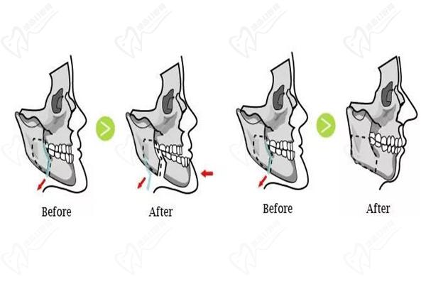 建议重度骨性畸形做正颌手术