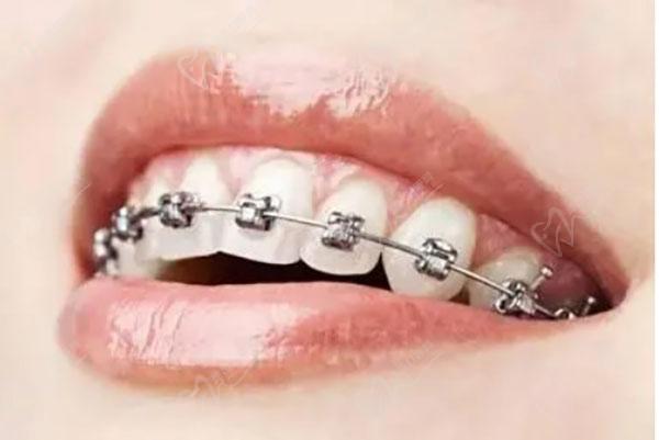 过了多少岁不建议牙齿矫正？
