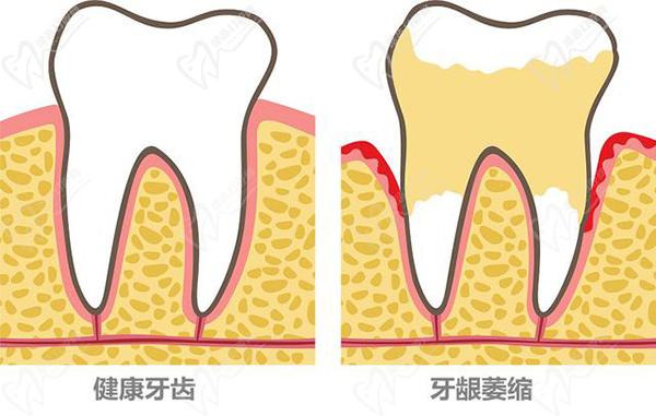 中医能治牙龈萎缩吗