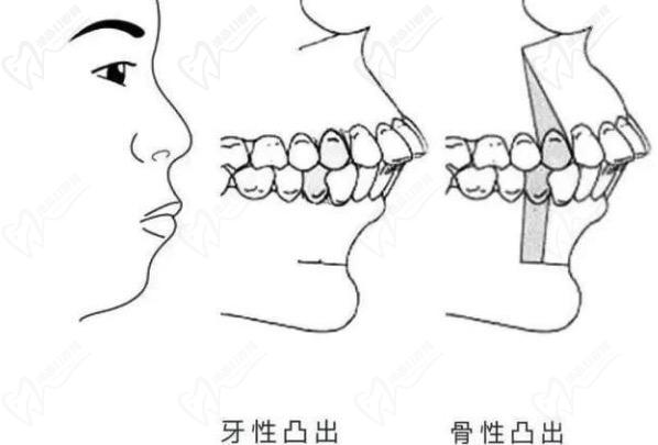 骨性嘴凸不拔牙可以矫正吗？