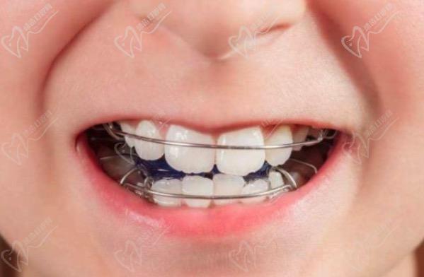 儿童矫正牙齿需要拔牙有危害吗？