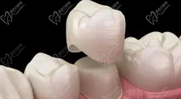种植牙临时牙冠