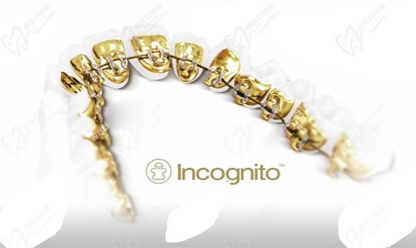 3M Incognito黄金舌侧矫治系统优势