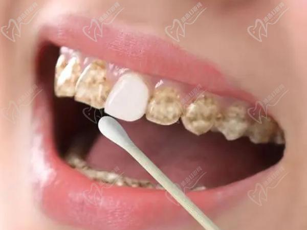 四环素牙是怎么形成的？临床表现如下，再看怎么才能变白？
