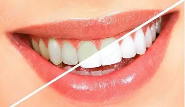 四环素牙是怎么形成的？临床表现如下，再看怎么才能变白？