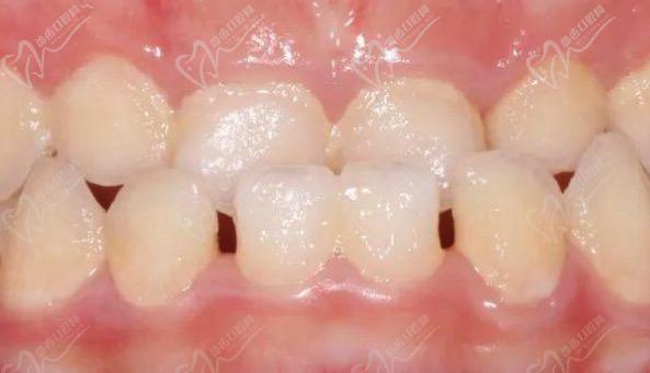 乳牙地包天换牙后会正常吗？