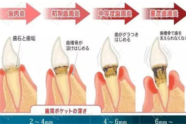 活动期牙周炎病理进程