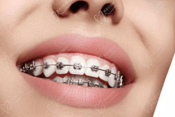 牙齿矫正的流程是怎样的