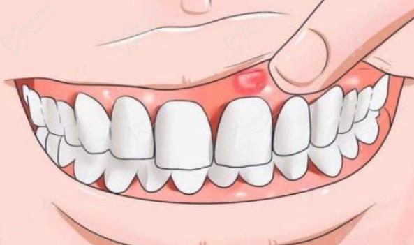 牙龈反复红肿是怎么回事？