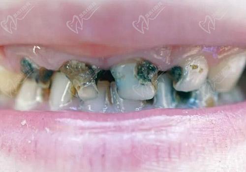 门牙缝隙发黑的危害有哪些
