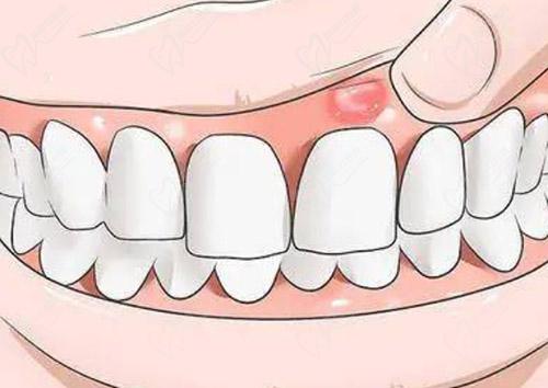 牙龈长个包是什么原因
