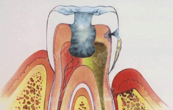 牙髓炎