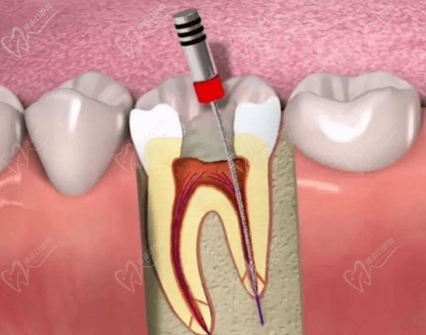 根管治疗