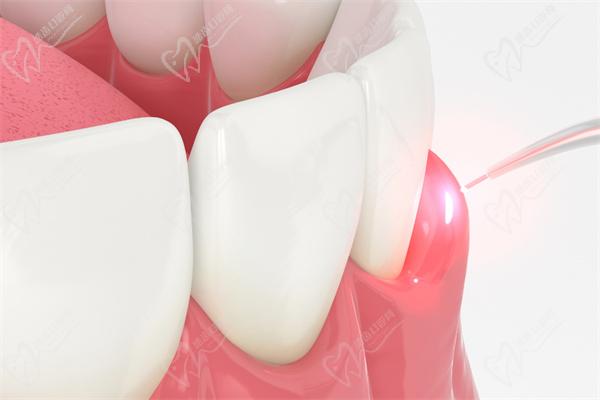 激光治疗牙龈增生