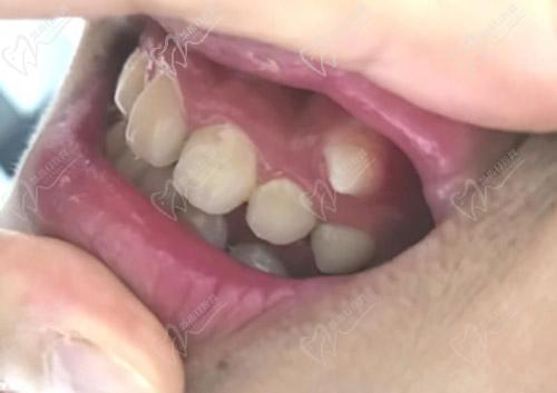 牙龈上长小牙齿的原因是什么