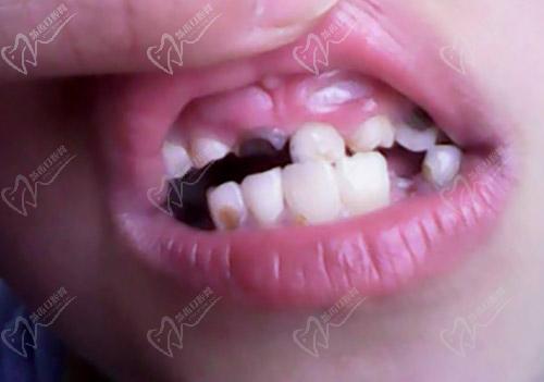 牙龈上长小牙齿是什么引起的