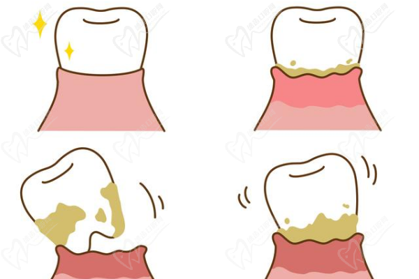 牙龈萎缩导致的牙缝大怎么修复？