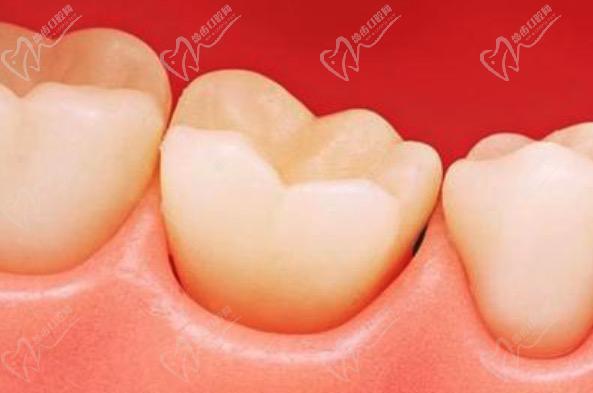 牙齿之间的牙龈可以再生吗？