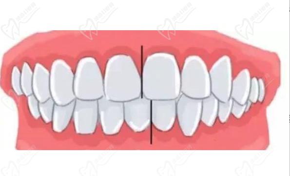 牙齿中线不齐脸会越来越歪吗？