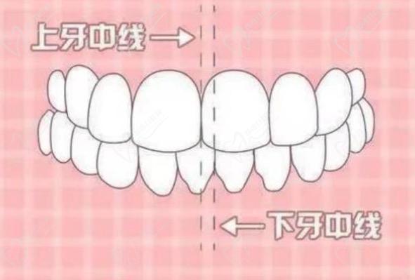 牙齿中线不齐脸会越来越歪吗？