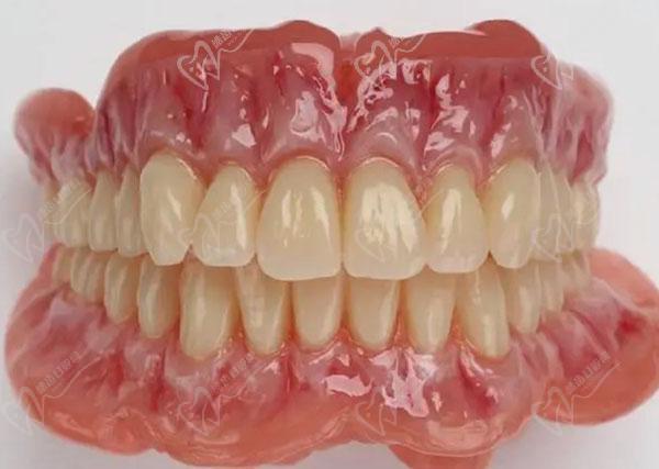 什么是无种植仿生牙？日式无种植仿生牙原理和寿命分别是什么呢