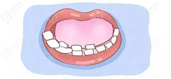 乳牙滞留是什么原因造成的
