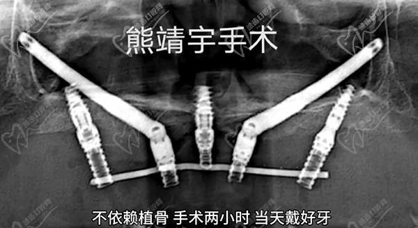 北京极简一站式口腔集采种植牙价格