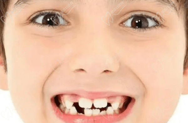 儿童牙齿