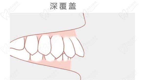 牙齿只深覆盖正常吗？深覆盖有必要矫正吗？看矫正后脸型变化