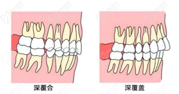 牙齿只深覆盖正常吗？深覆盖有必要矫正吗？看矫正后脸型变化