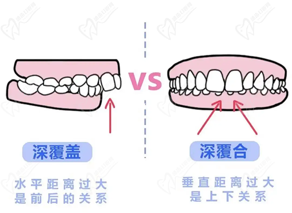 牙齿只深覆盖正常吗？深覆盖有必要矫正吗？看矫正后脸型变化